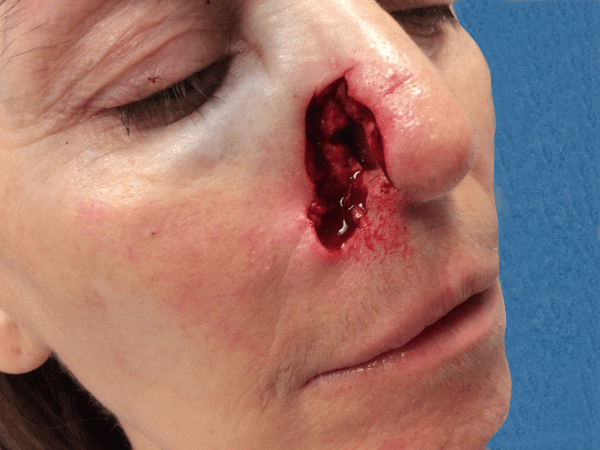 infiltrative basal cell carcinoma