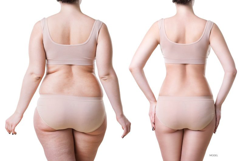 How Is Fat Prepared for Removal During Liposuction?
