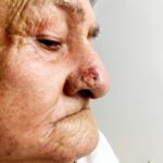 Mohs Nose Patient 27 Thumbnail Before
