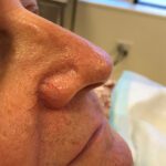 Mohs Nose Patient 28 Thumbnail Before