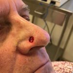 Mohs Nose Patient 28 Thumbnail After
