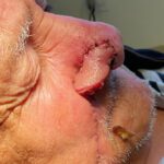 Mohs Nose Patient 27 Thumbnail After - 2