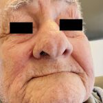 Mohs Nose Patient 27 Thumbnail After - 4