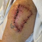 Mohs Arm Patient 01 Thumbnail Before - 2