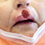 Mohs Lips Patient 14 Thumbnail After