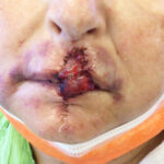 Mohs Lips Patient 14 Thumbnail Before - 2