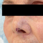 Mohs Nose Patient 29 Thumbnail Before