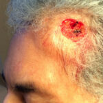 Mohs Patient Scalp 04 Thumbnail After