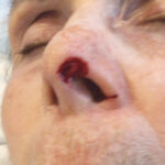 Mohs Nose Patient 29 Thumbnail After