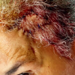 Mohs Patient Scalp 04 Thumbnail Before - 2