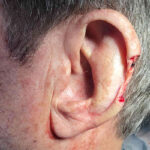 Mohs Ear Patient 13 Thumbnail After