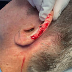 Mohs Ear Patient 13 Thumbnail Before - 2