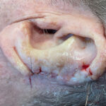 Mohs Ear Patient 13 Thumbnail After - 2