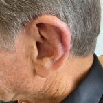 Mohs Ear Patient 13 Thumbnail After - 3